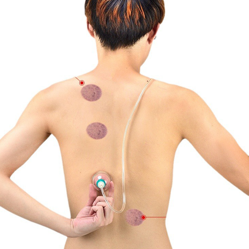⏳Offre spéciale à durée limitée⏰Kit de ventouses – Ventouses épaisses, pompe d'aspiration, transparent 🩺